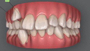 矯正治療で健康になれる