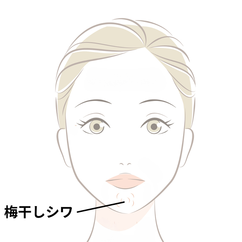 歯並びが悪いと梅干しシワ