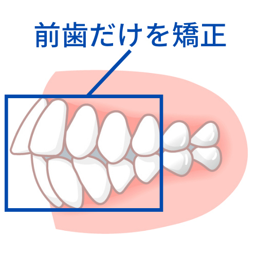 前歯だけの矯正を無理に実行